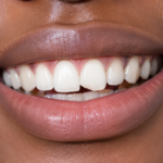Close-up of a chipped front tooth before cosmetic repair at a Nairobi CBD dental clinic.