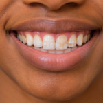 Close-up of front teeth showing mild dental fluorosis in Kenya with white flecks and light brown patches.
