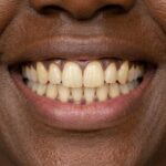 Close-up of a smile showing early signs of tooth discolouration.