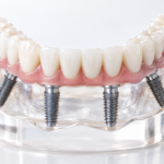 All-on-4 dental implants model showing a full-arch bridge on four implants.