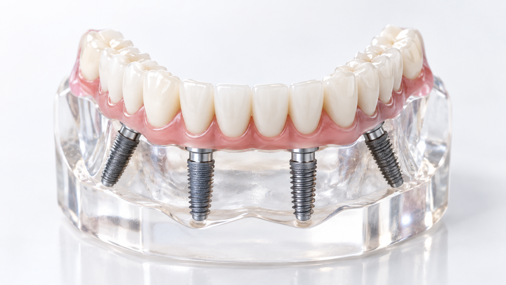 All-on-4 dental implants model showing a full-arch bridge on four implants.