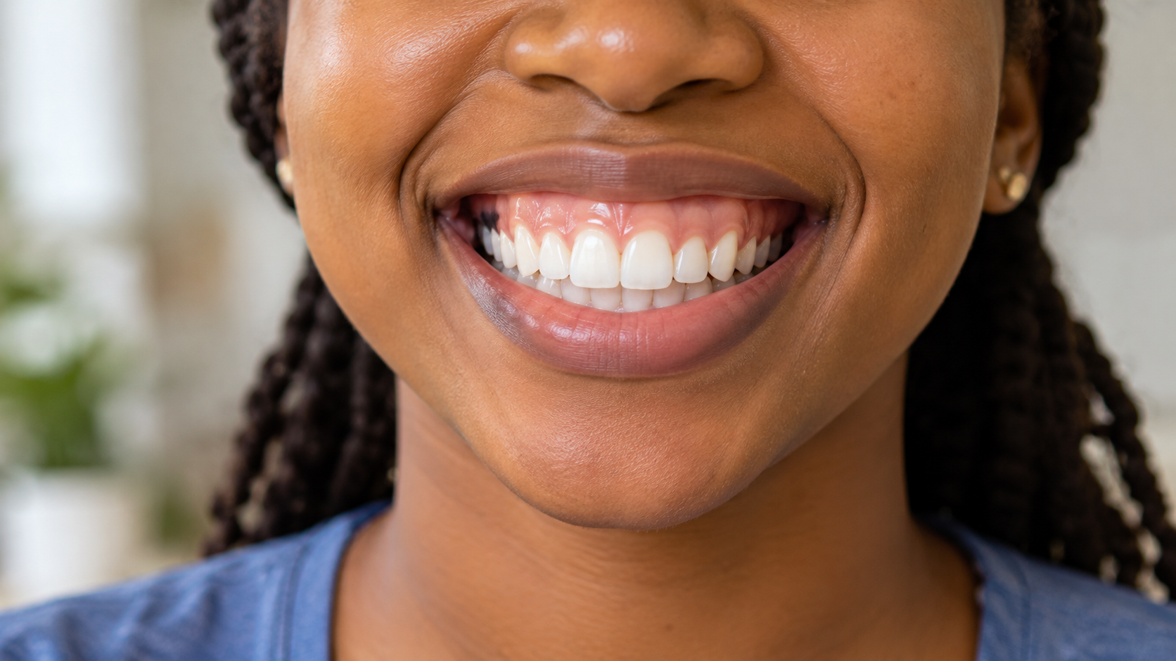 Smiling adult showing a gummy smile with a band of gum above the upper teeth.