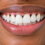 Close-up of a smile showing black triangles between teeth near the gumline.