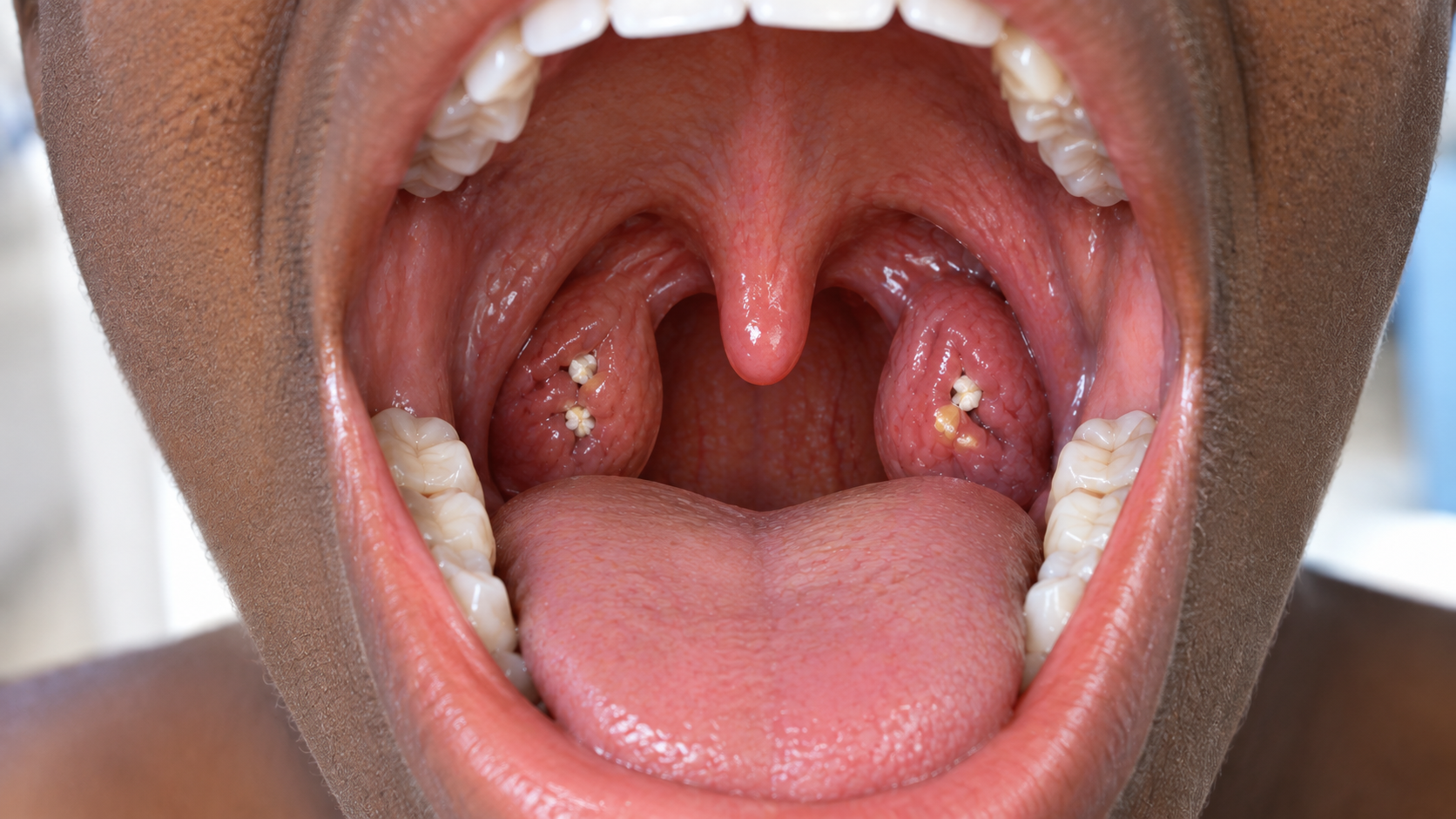 Illustration of the back of the throat showing small white tonsil stones in the tonsil crypts.